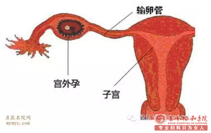 金华宫外孕有什么症状